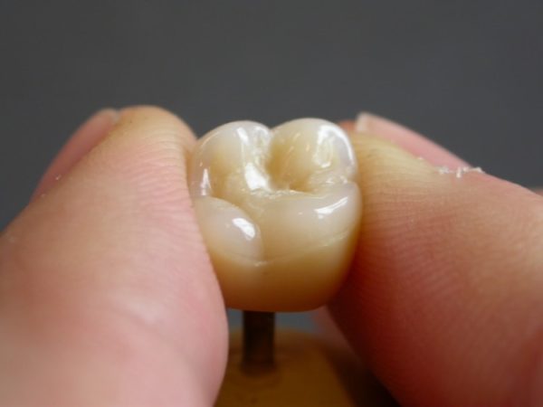 04_dental_crown_toot_mejfc-600x450