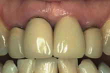 CS_Renishaw_Fig 3_Old ceramic crowns