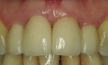 CS_Renishaw_Fig 4_New incise metal-free crowns