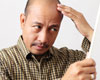 Hair-transplant-surgery-100px