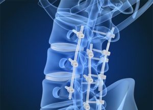 Orthopaedic-implant-xray-555x400-1-300x216